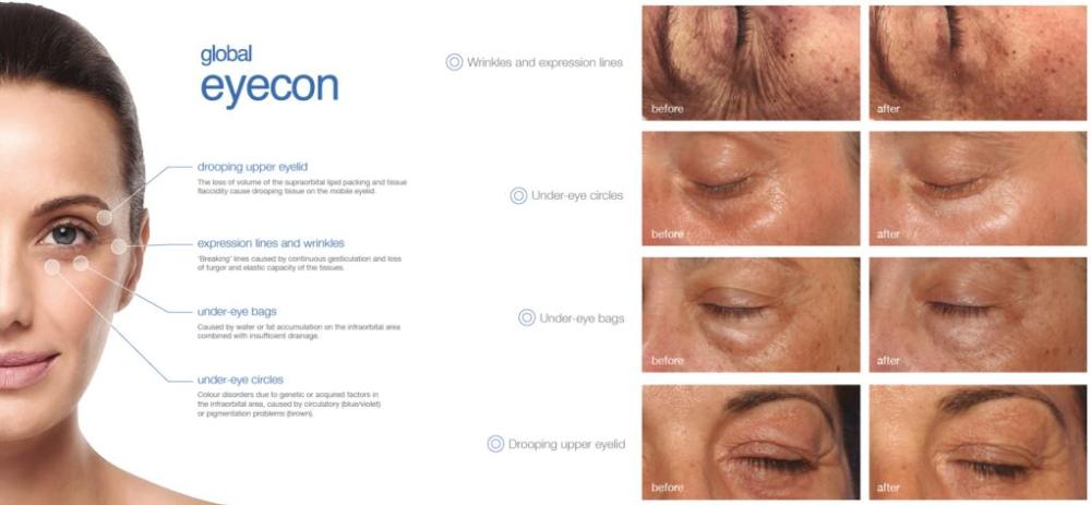 eyecon eye treatment